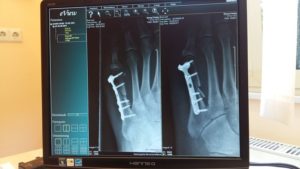 bone fracture